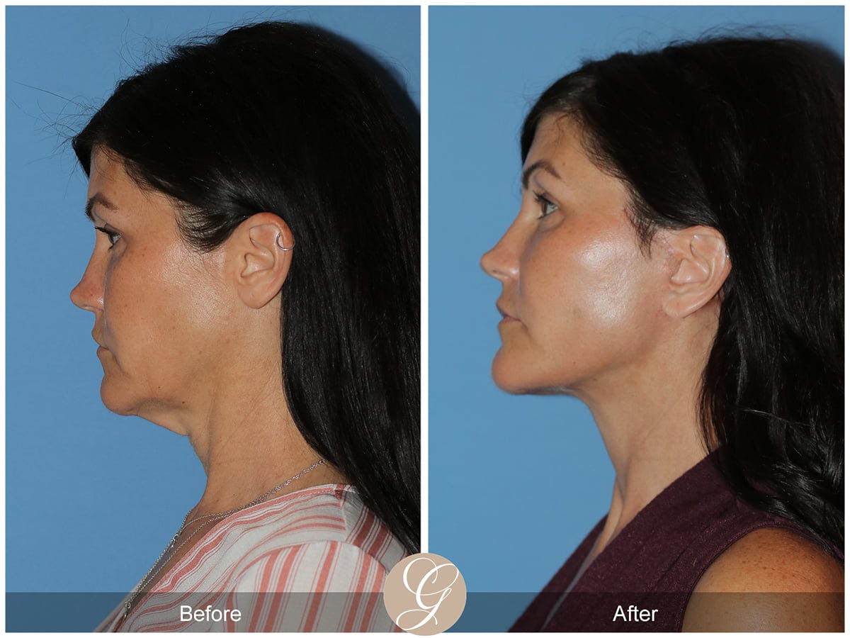 Preservation Facelift Before & After Gallery - Patient 244551 - Image 2