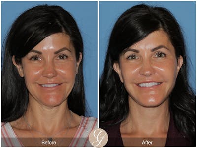 Preservation Facelift Before & After Gallery - Patient 244551 - Image 1