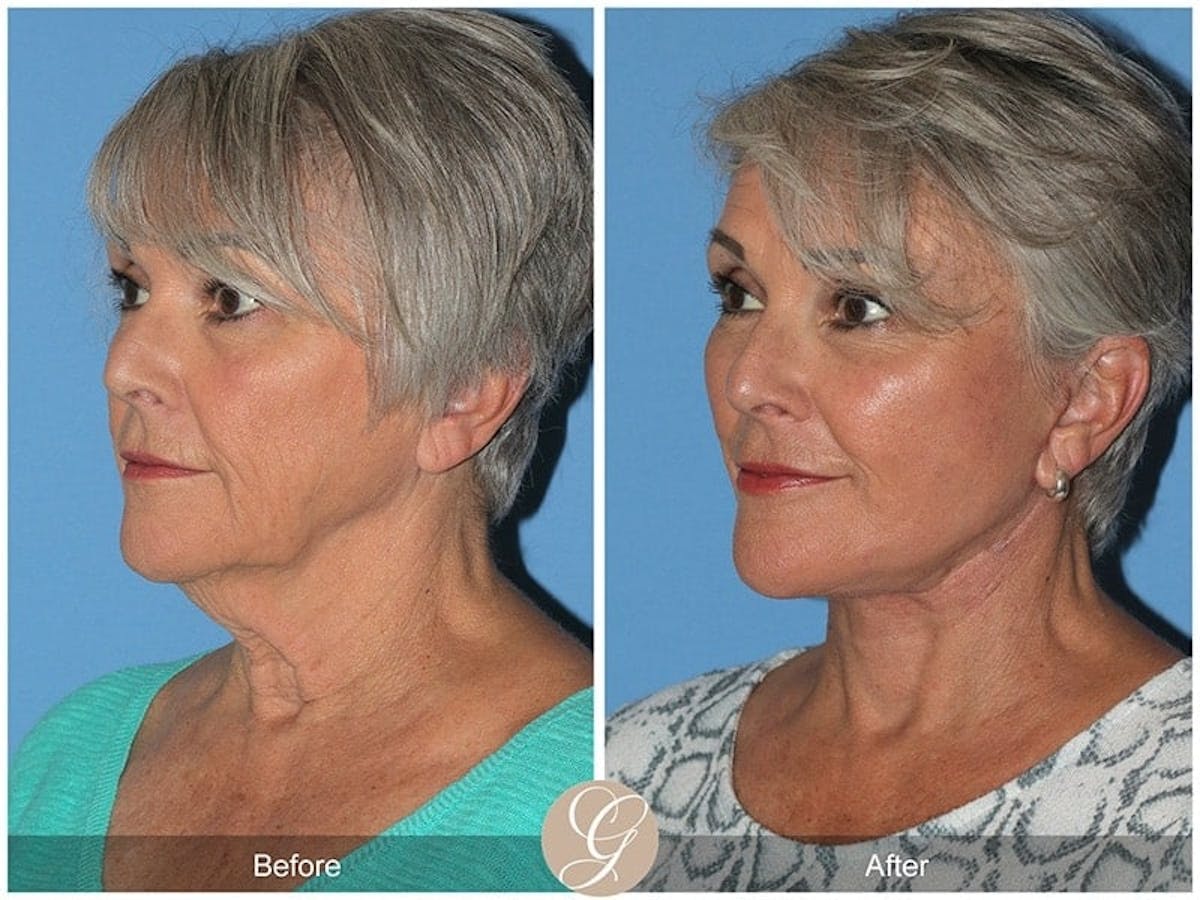Preservation Facelift Before & After Gallery - Patient 238777 - Image 2