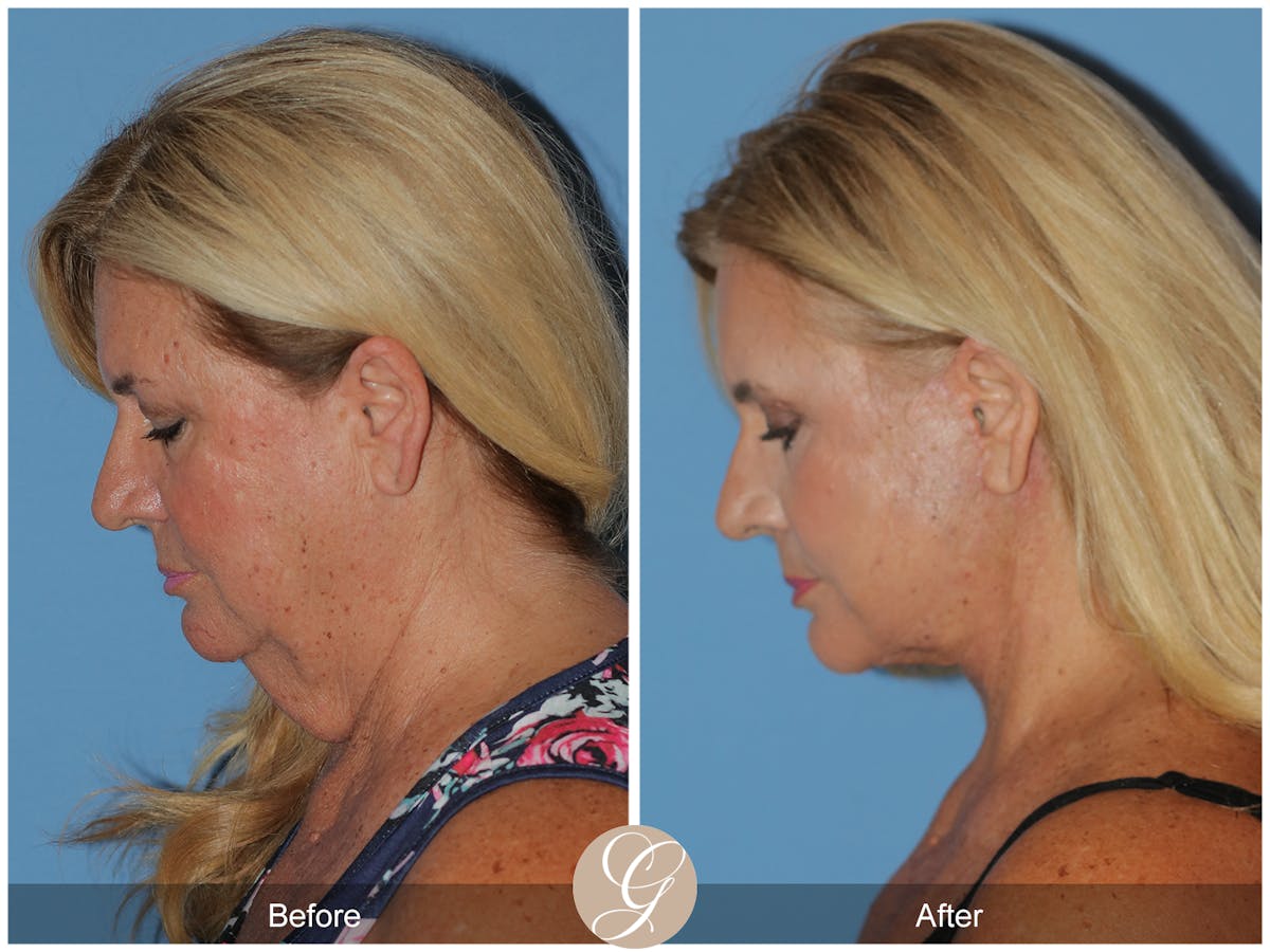 Preservation Facelift Before & After Gallery - Patient 415427 - Image 3