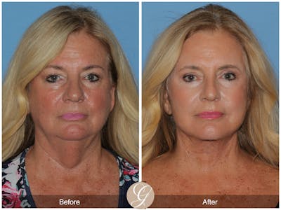 Preservation Facelift Before & After Gallery - Patient 415427 - Image 1