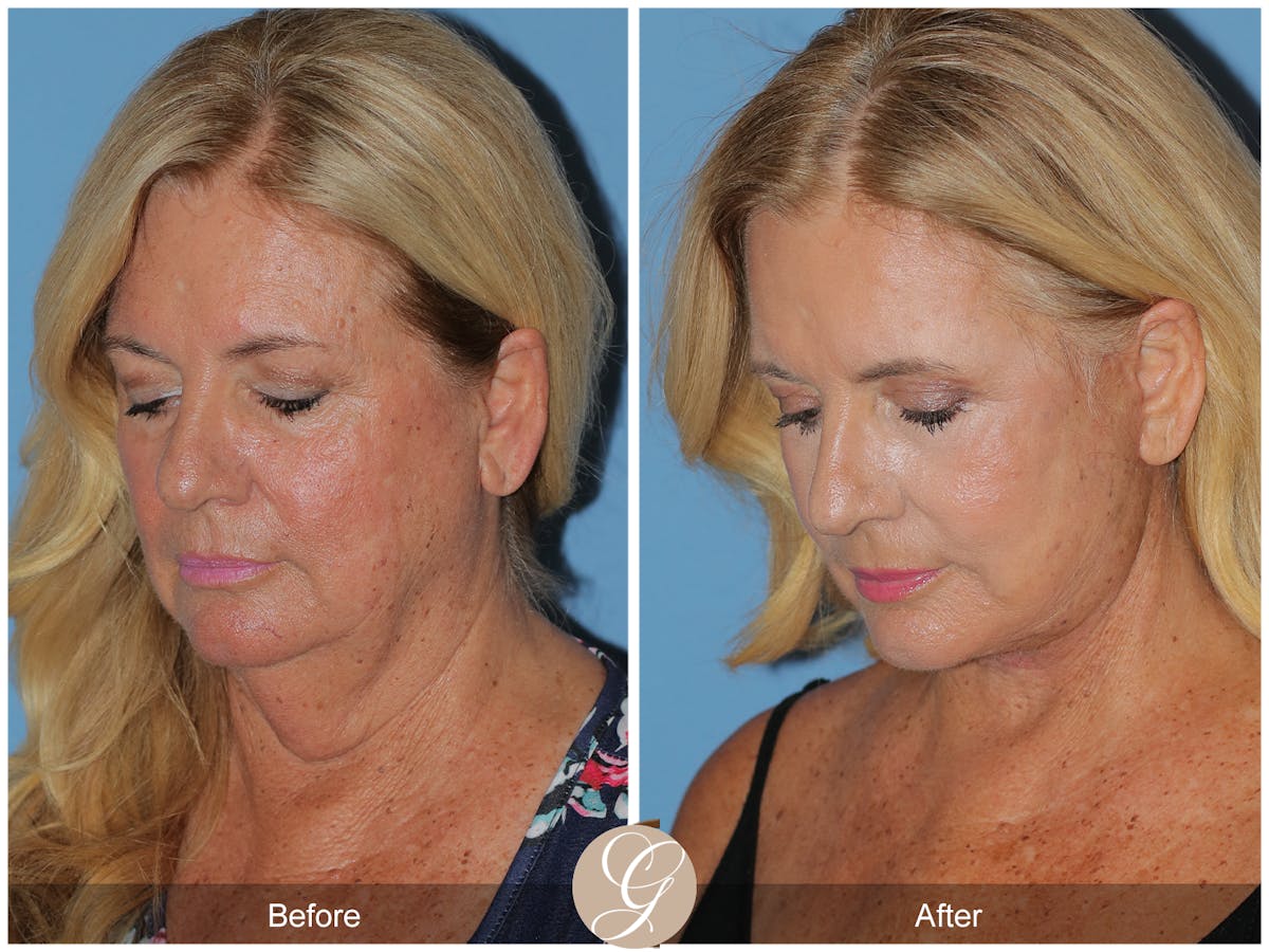 Preservation Facelift Before & After Gallery - Patient 415427 - Image 2