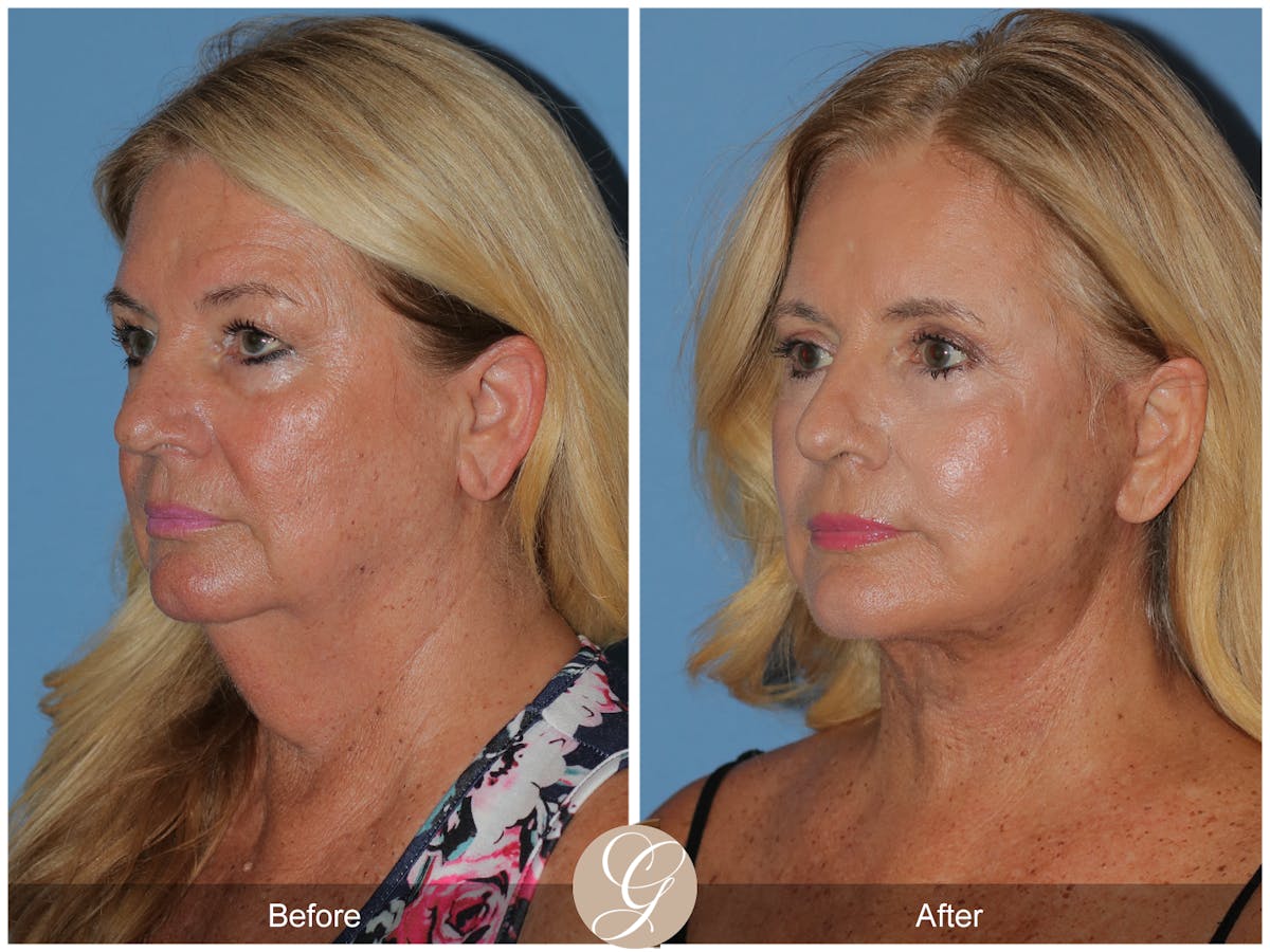 Preservation Facelift Before & After Gallery - Patient 415427 - Image 4