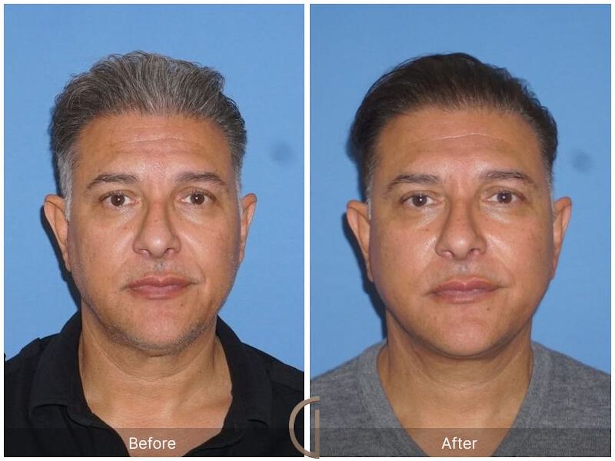 Facelift Male Before & After Gallery - Patient 132377 - Image 1