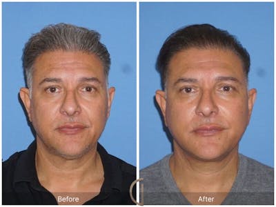 Facelift Male Before & After Gallery - Patient 132377 - Image 1