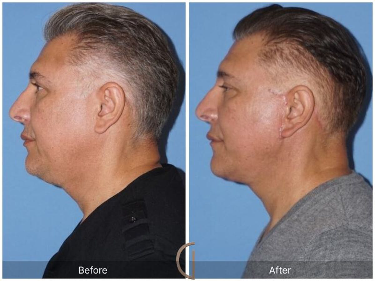 Facelift Male Before & After Gallery - Patient 132377 - Image 2