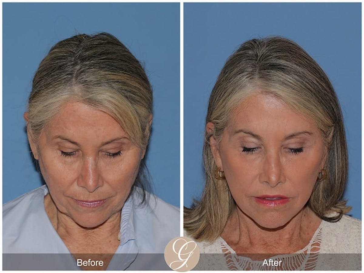 Preservation Facelift Before & After Gallery - Patient 829855 - Image 2