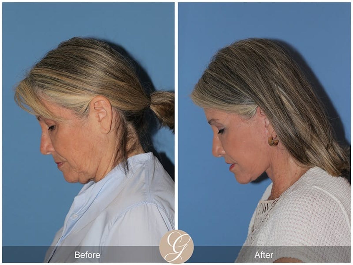Preservation Facelift Before & After Gallery - Patient 829855 - Image 5