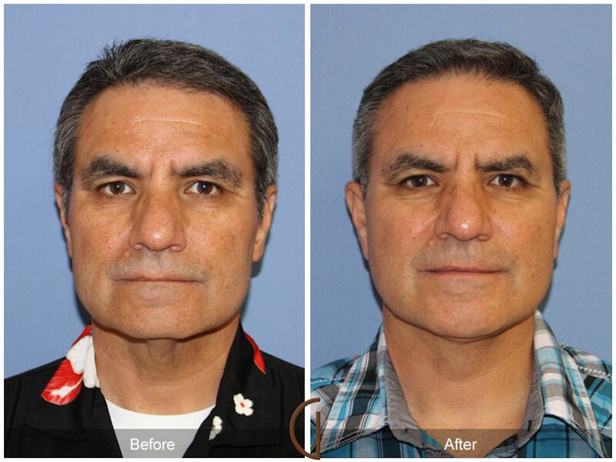Facelift Male Before & After Gallery - Patient 172226 - Image 1