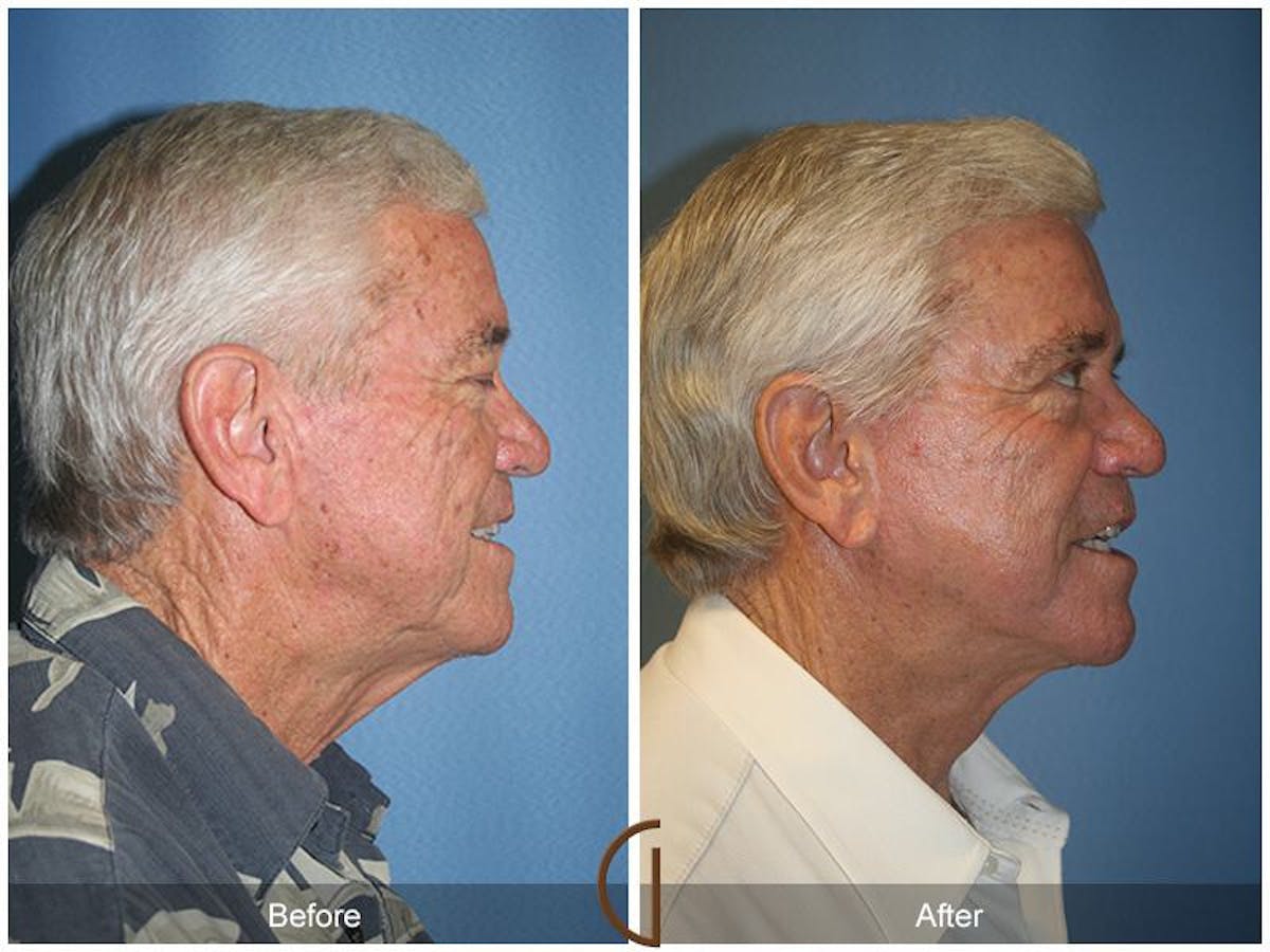 Facelift Male Before & After Gallery - Patient 186940 - Image 3