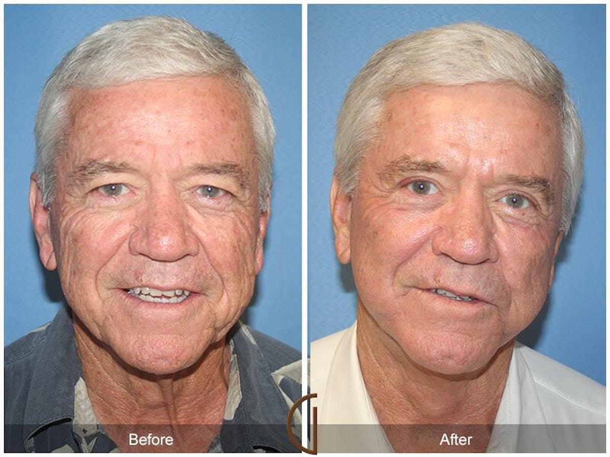 Facelift Male Before & After Gallery - Patient 186940 - Image 1