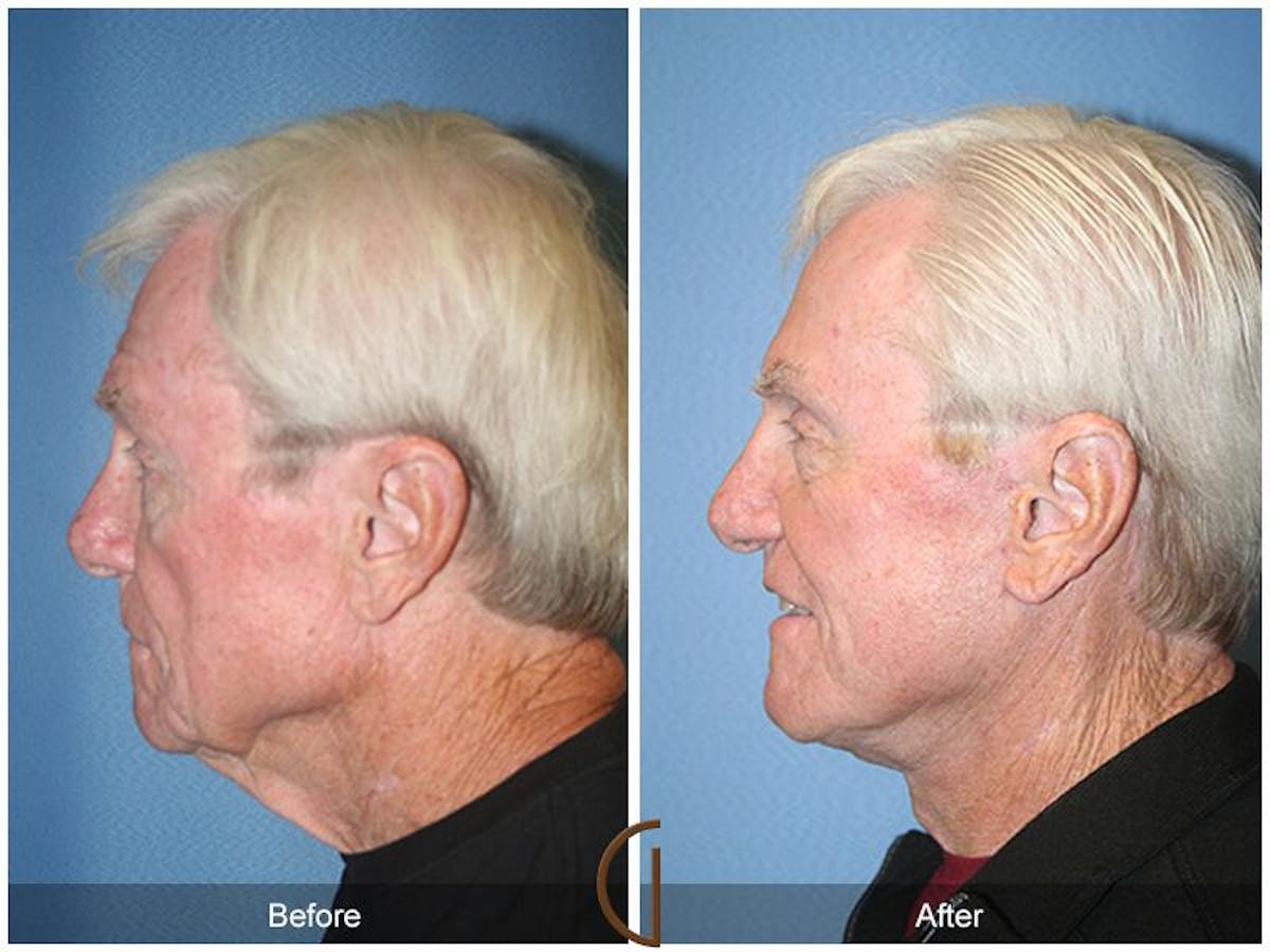 Facelift Male Before & After Gallery - Patient 162424 - Image 2