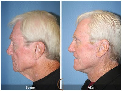 Neck Lift Before & After Gallery - Patient 416347 - Image 1
