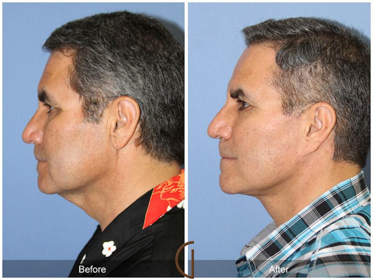 Facelift Male Before & After Gallery - Patient 172226 - Image 2