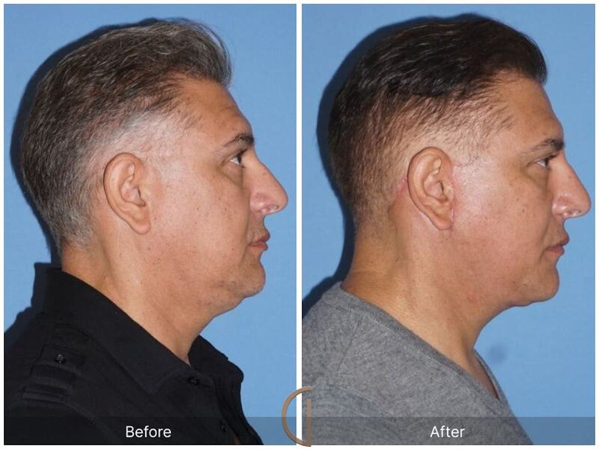 Facelift Male Before & After Gallery - Patient 132377 - Image 3