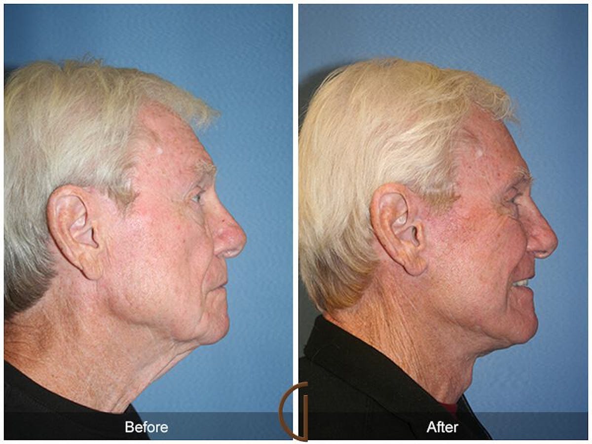 Facelift Male Before & After Gallery - Patient 162424 - Image 3