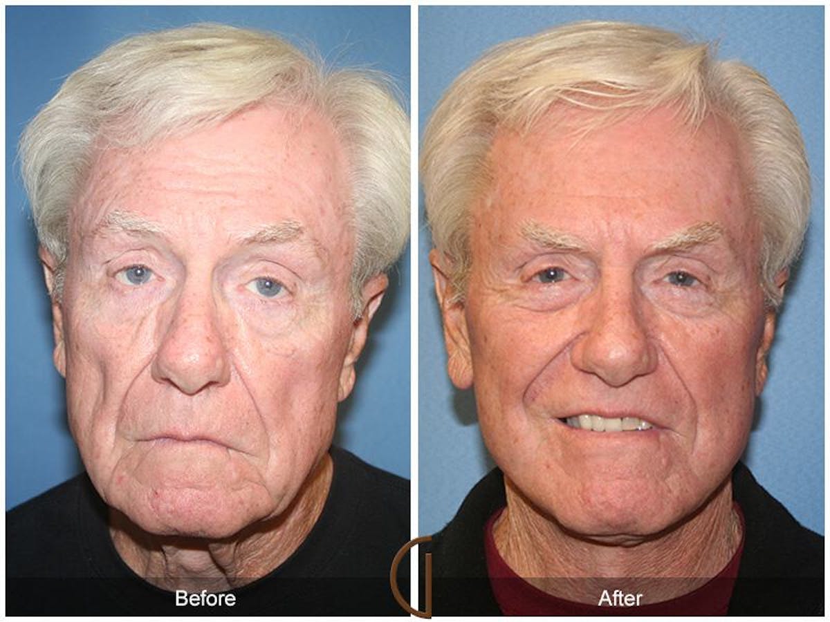 Facelift Male Before & After Gallery - Patient 162424 - Image 1