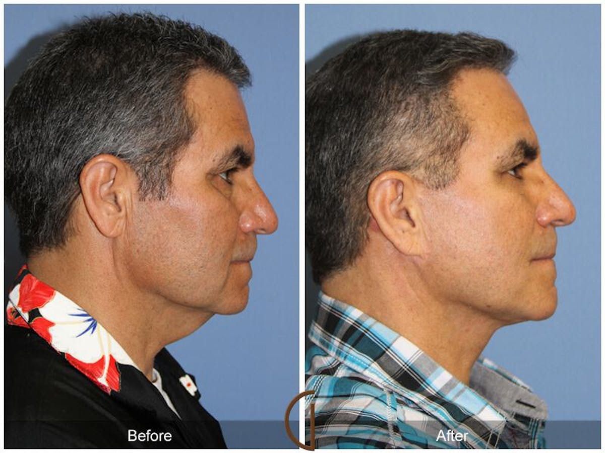Facelift Male Before & After Gallery - Patient 172226 - Image 3