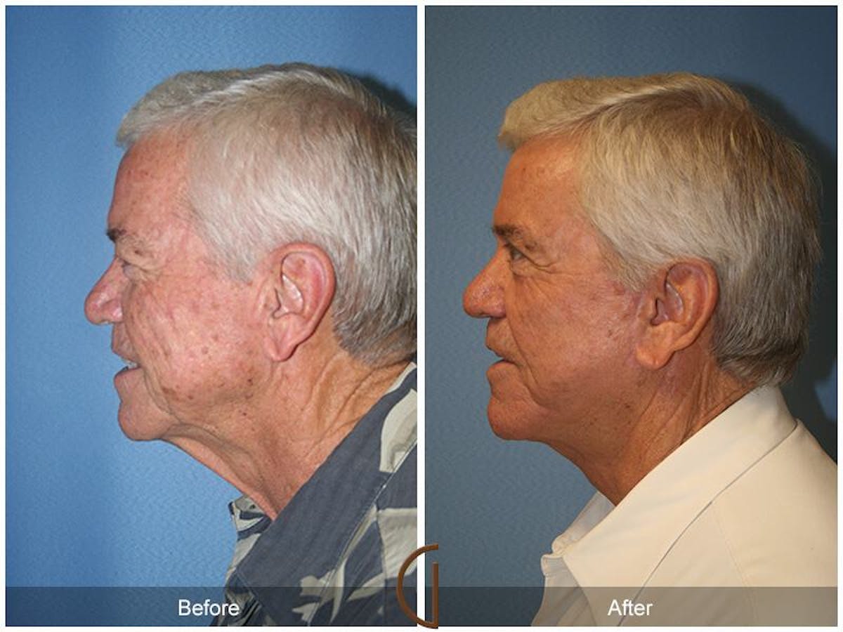 Facelift Male Before & After Gallery - Patient 186940 - Image 2