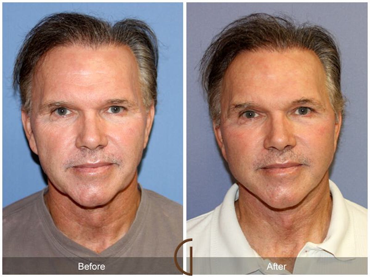 Facelift Male Before & After Gallery - Patient 339954 - Image 1