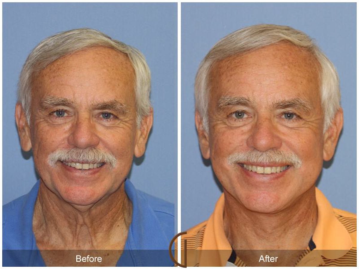 Facelift Male Before & After Gallery - Patient 351216 - Image 1