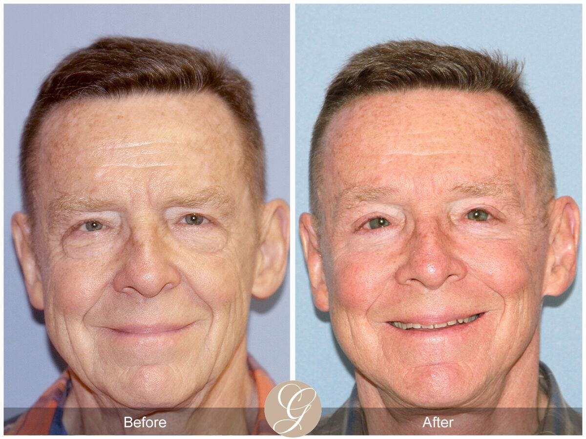 Facelift Male Before & After Gallery - Patient 149498 - Image 1