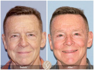 Facelift Male Before & After Gallery - Patient 149498 - Image 1