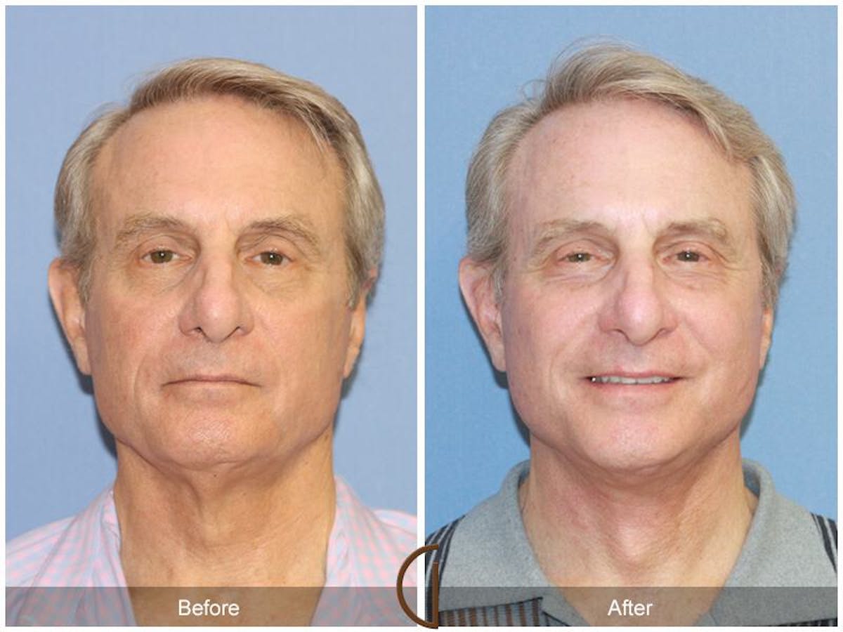 Facelift Male Before & After Gallery - Patient 330257 - Image 1