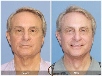 Facelift Male Before & After Gallery - Patient 330257 - Image 1