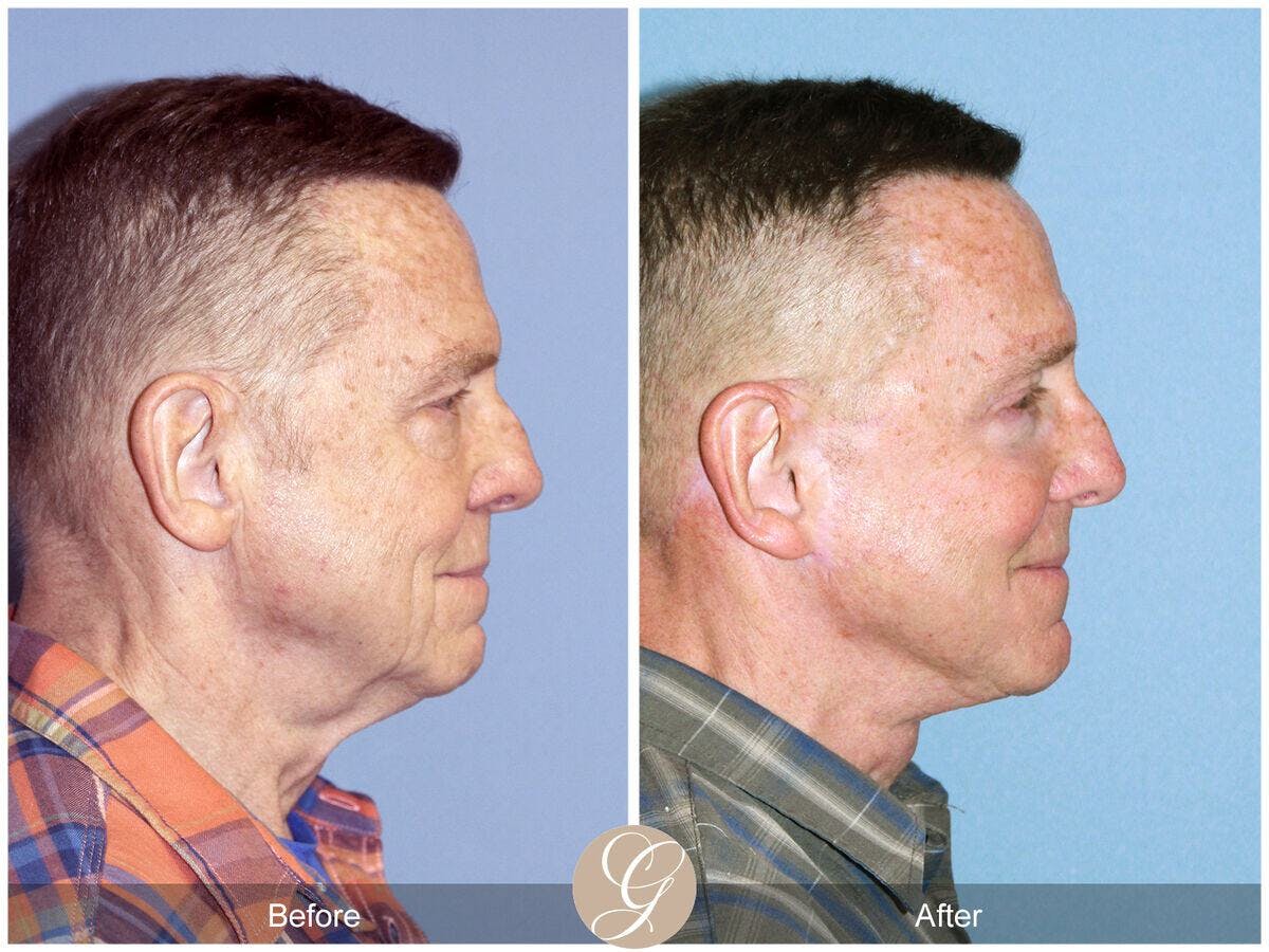 Facelift Male Before & After Gallery - Patient 149498 - Image 3