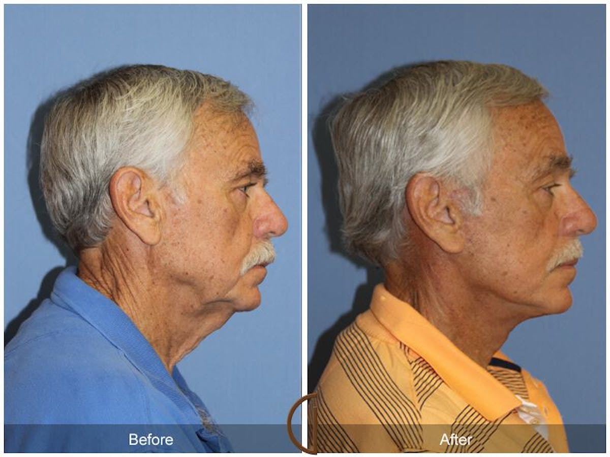 Facelift Male Before & After Gallery - Patient 351216 - Image 3