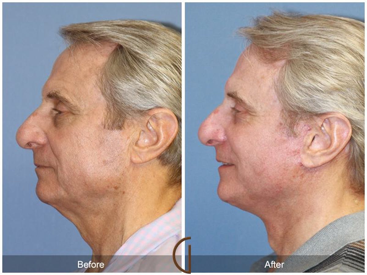 Facelift Male Before & After Gallery - Patient 330257 - Image 2
