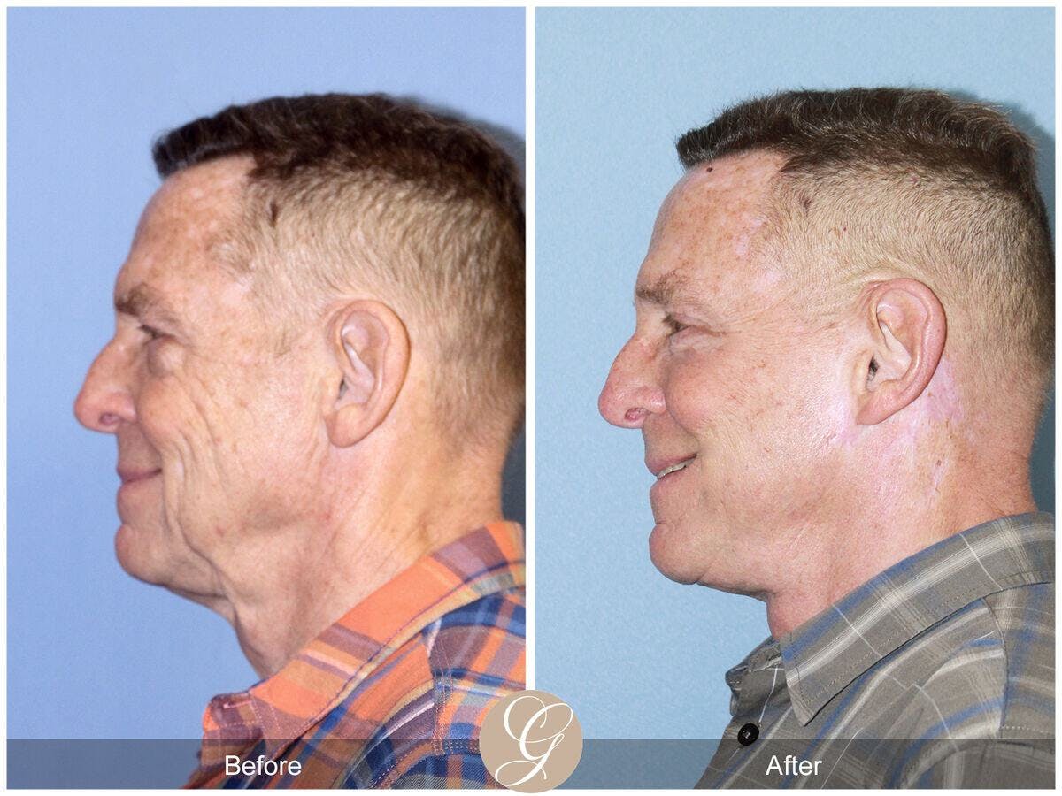 Facelift Male Before & After Gallery - Patient 149498 - Image 2