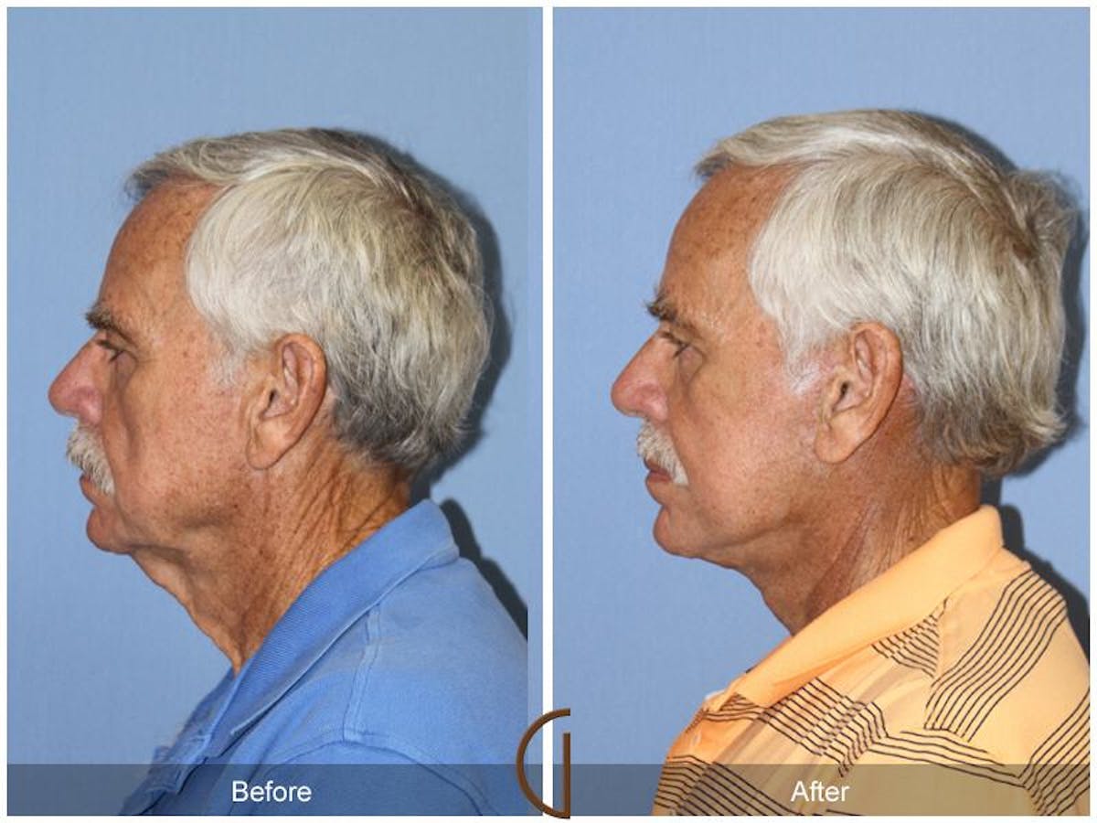 Facelift Male Before & After Gallery - Patient 351216 - Image 2