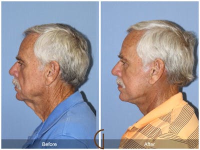 Neck Lift Before & After Gallery - Patient 410057 - Image 1