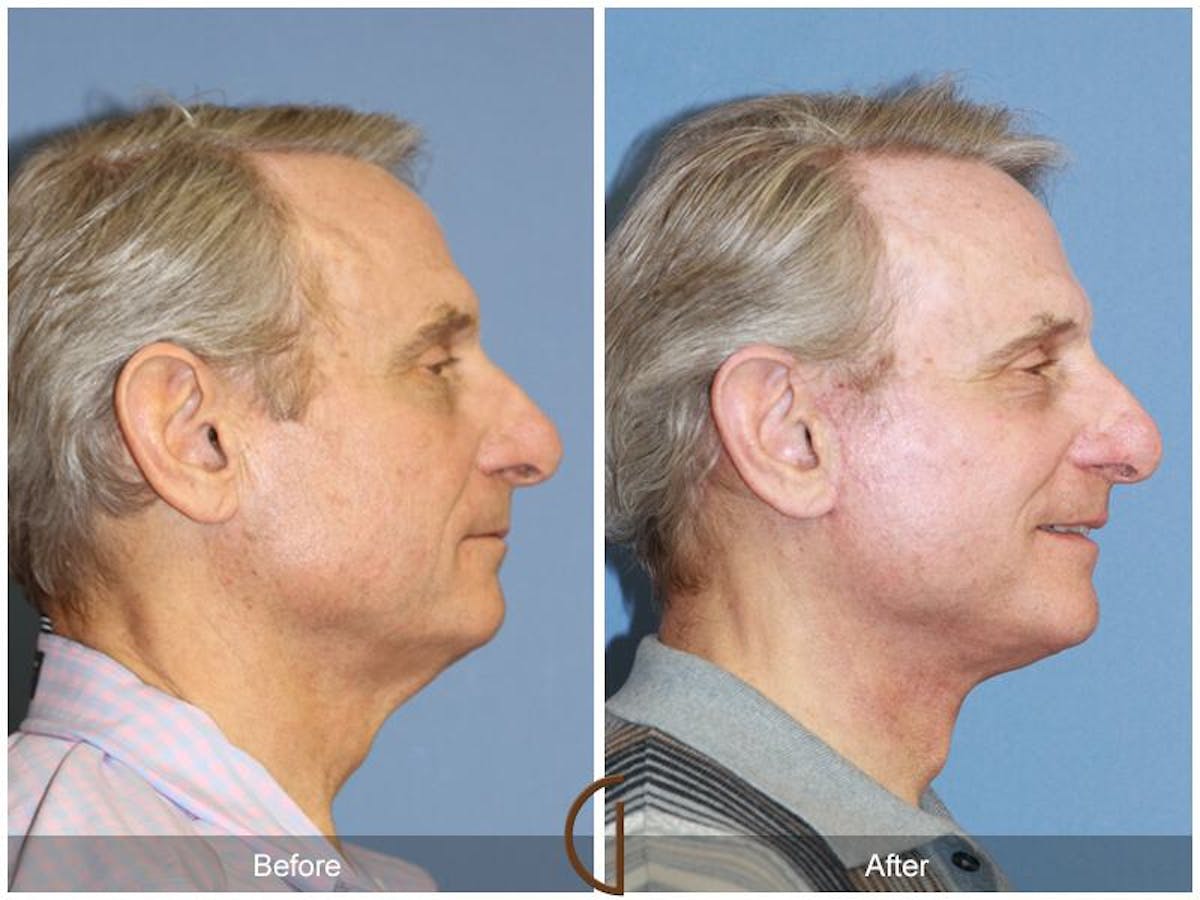 Facelift Male Before & After Gallery - Patient 330257 - Image 3