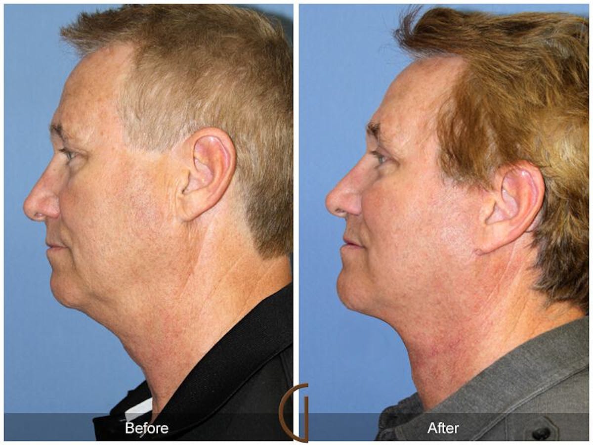 Facelift Male Before & After Gallery - Patient 613457 - Image 2