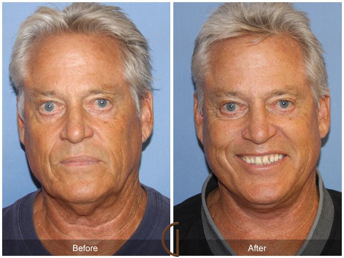 Facelift Male Before & After Gallery - Patient 229825 - Image 1
