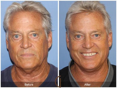 Facelift Male Before & After Gallery - Patient 229825 - Image 1