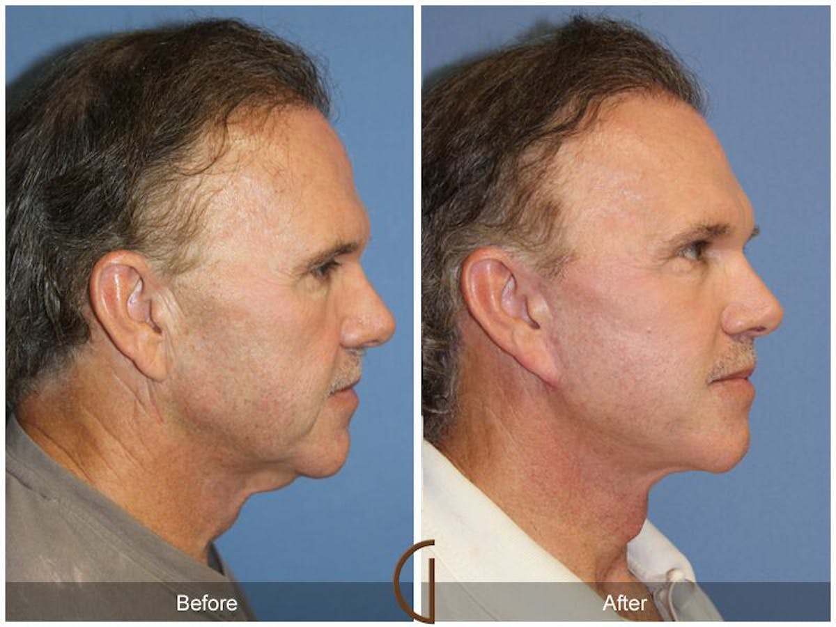 Facelift Male Before & After Gallery - Patient 339954 - Image 3