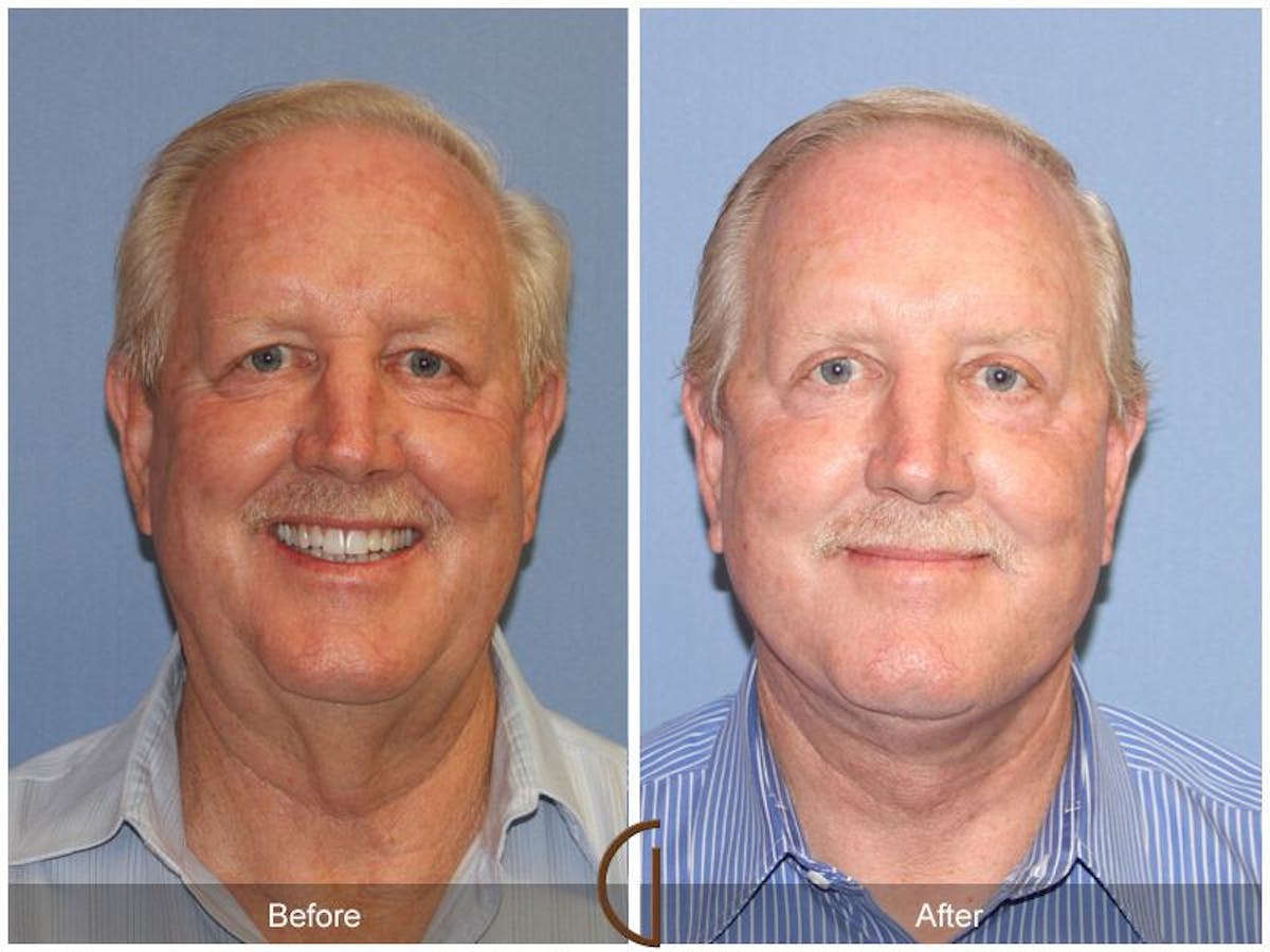 Facelift Male Before & After Gallery - Patient 177130 - Image 1