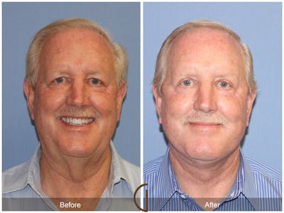 Facelift Male Before & After Gallery - Patient 177130 - Image 1