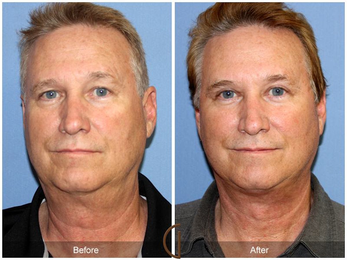 Facelift Male Before & After Gallery - Patient 613457 - Image 1