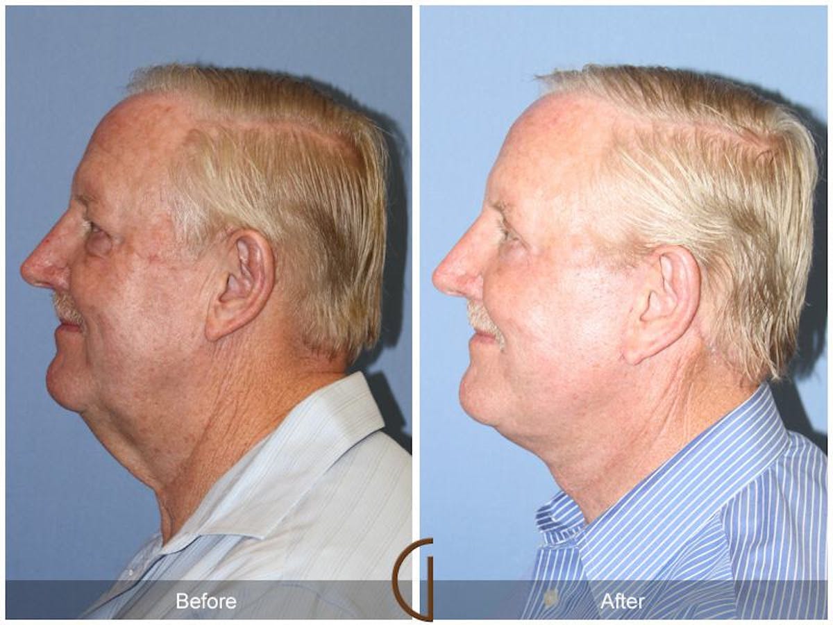 Facelift Male Before & After Gallery - Patient 177130 - Image 2