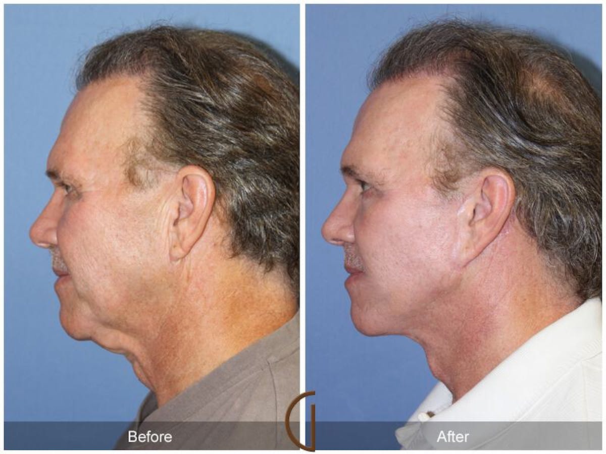 Facelift Male Before & After Gallery - Patient 339954 - Image 2