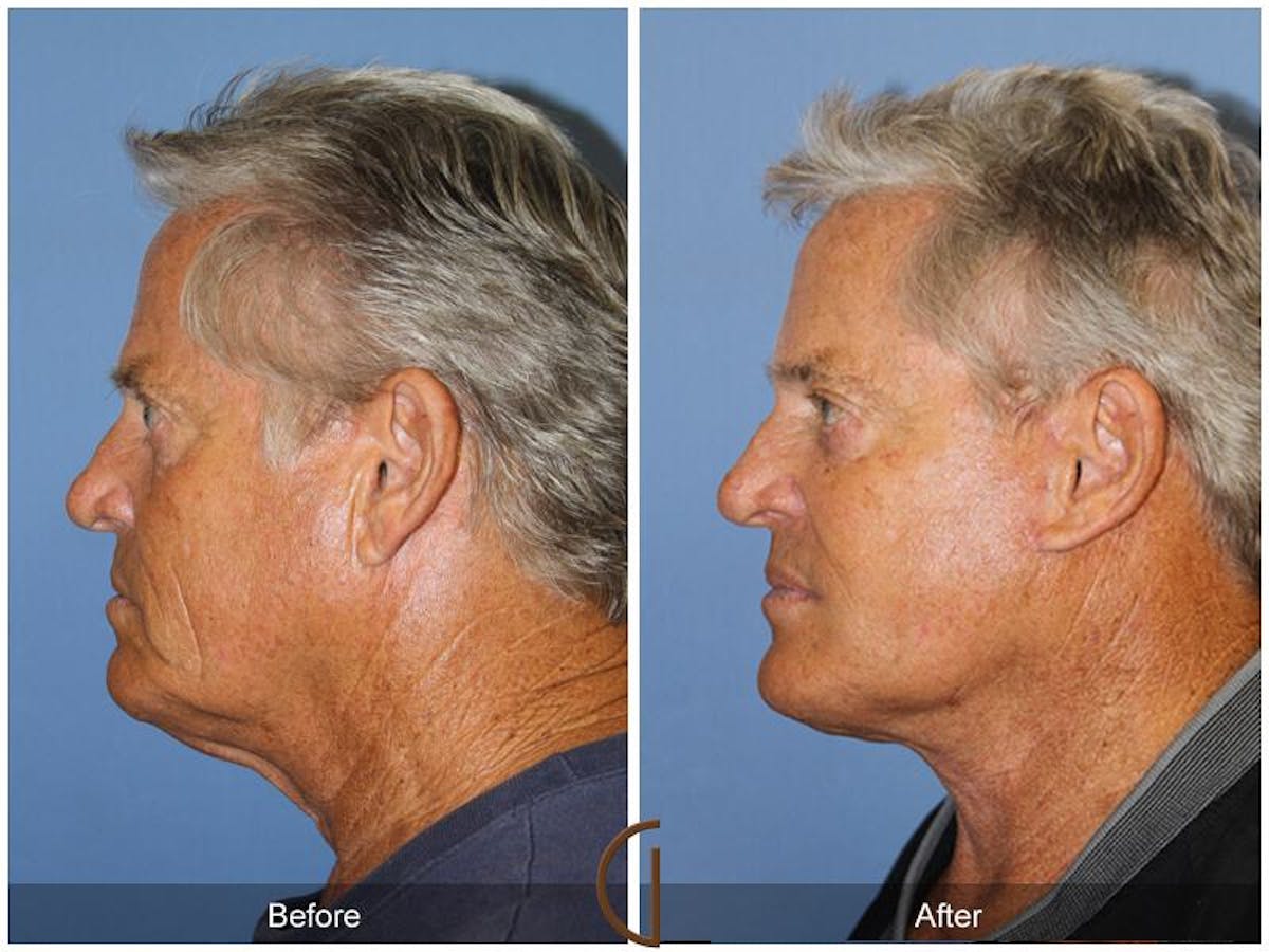 Facelift Male Before & After Gallery - Patient 229825 - Image 2