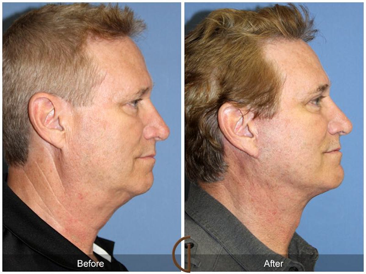 Facelift Male Before & After Gallery - Patient 613457 - Image 3