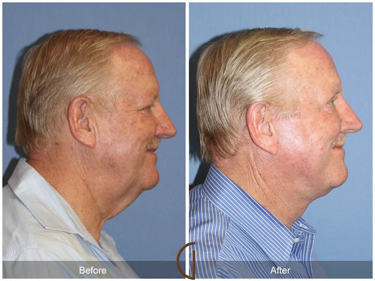 Facelift Male Before & After Gallery - Patient 177130 - Image 3