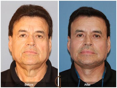 Facelift Male Before & After Gallery - Patient 304037 - Image 1