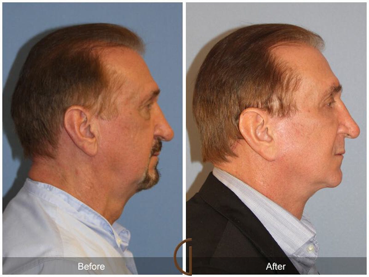 Facelift Male Before & After Gallery - Patient 173259 - Image 3